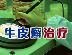 银屑病有哪些治疗方式