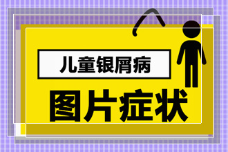 牛皮癣对于儿童方面通常的危害有哪些